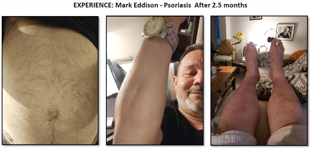 Mark Eddison's legs after 2.5 months of Clean Slate showing complete healing of psoriasis with healthy, clear skin